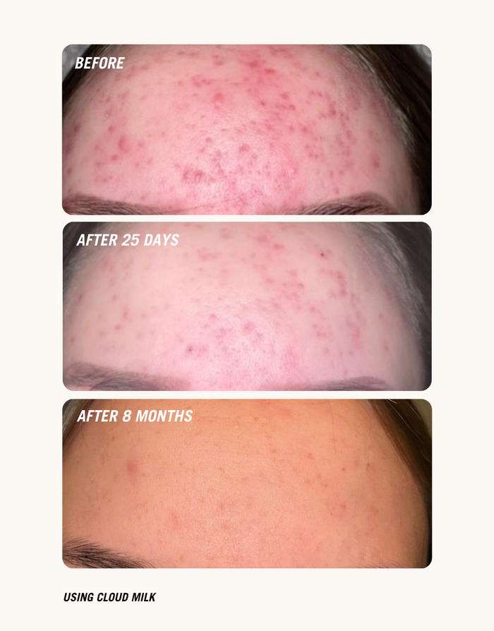 Before and after comparison of skin treatment using Cloud Milk over 8 months.