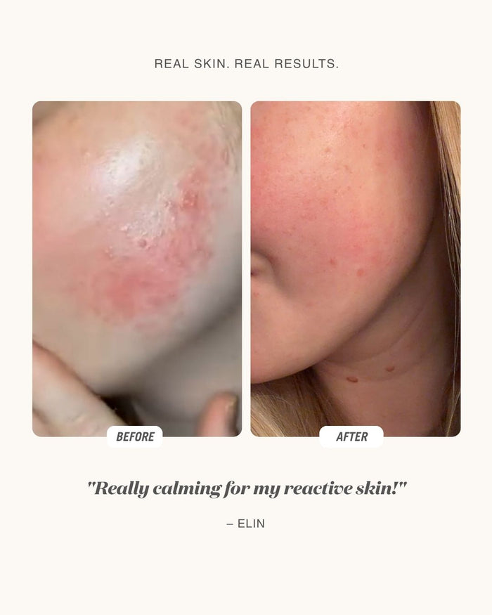 Before and after comparison of a person's face showing skin improvement, with the text 'REAL SKIN. REAL RESULTS.