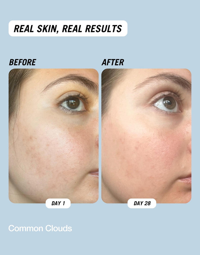 Befor and after images showing the results after using Common Clouds Cloud Water BHA toner.