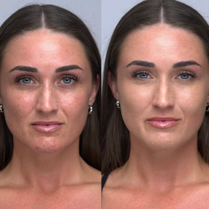 Concealer for hyperpigmentation before and after