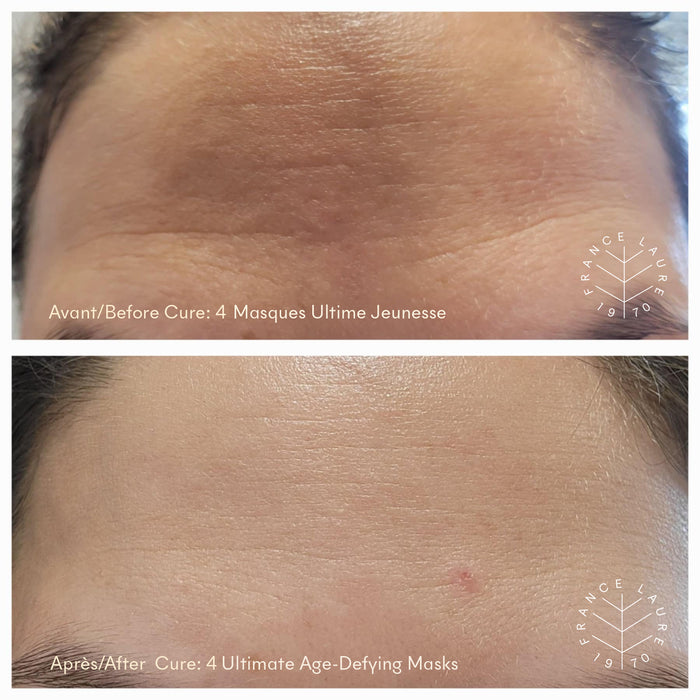 Before and after forehead skin transformation showing reduced wrinkles after 4 age-defying masks, natural glow achieved